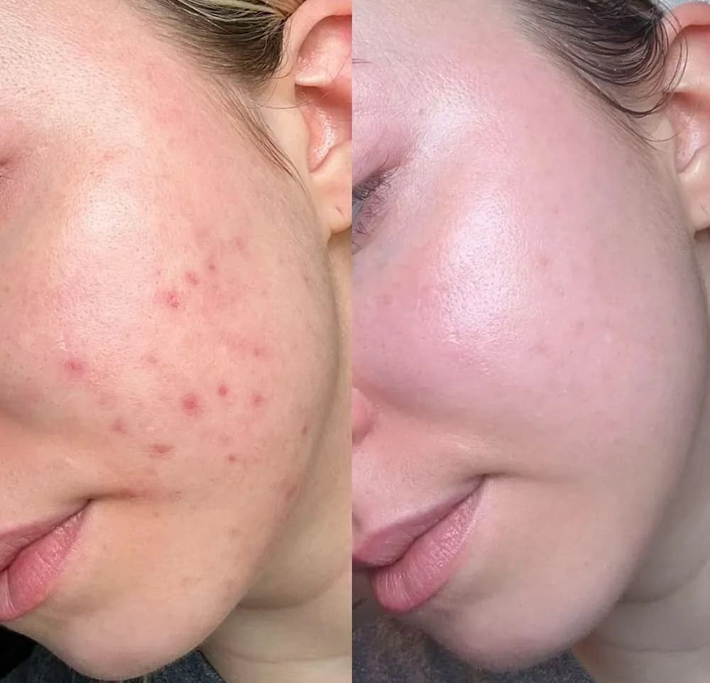Acne Recovery
