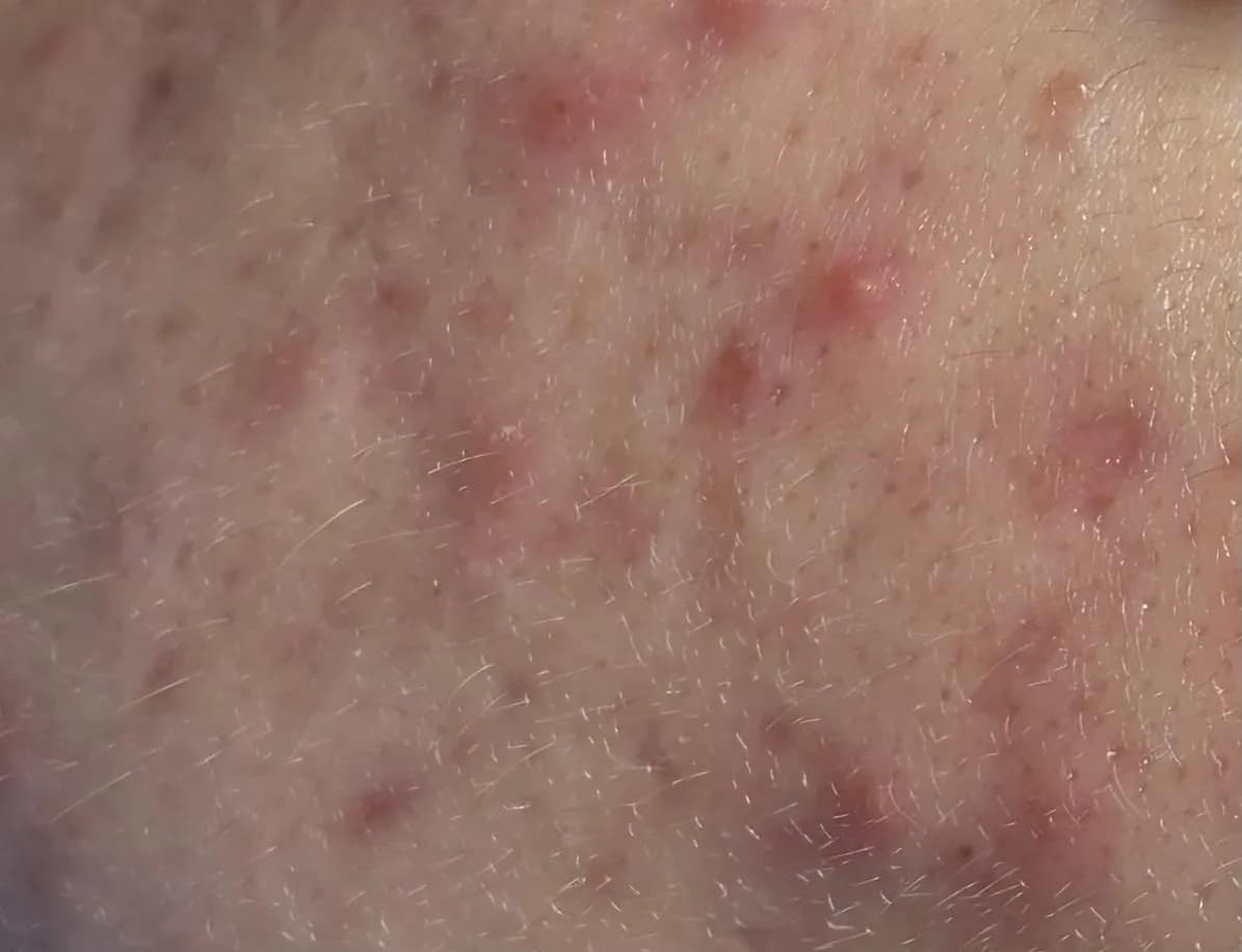 Acne & Clogged Pores