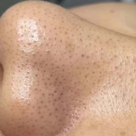 Blackheads