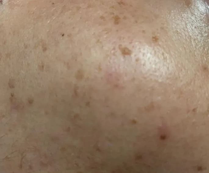 Dark Spot / Pigmentation